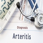 Temporal Arteritis: כיצד מטפלים בדלקת עורק הרקה?